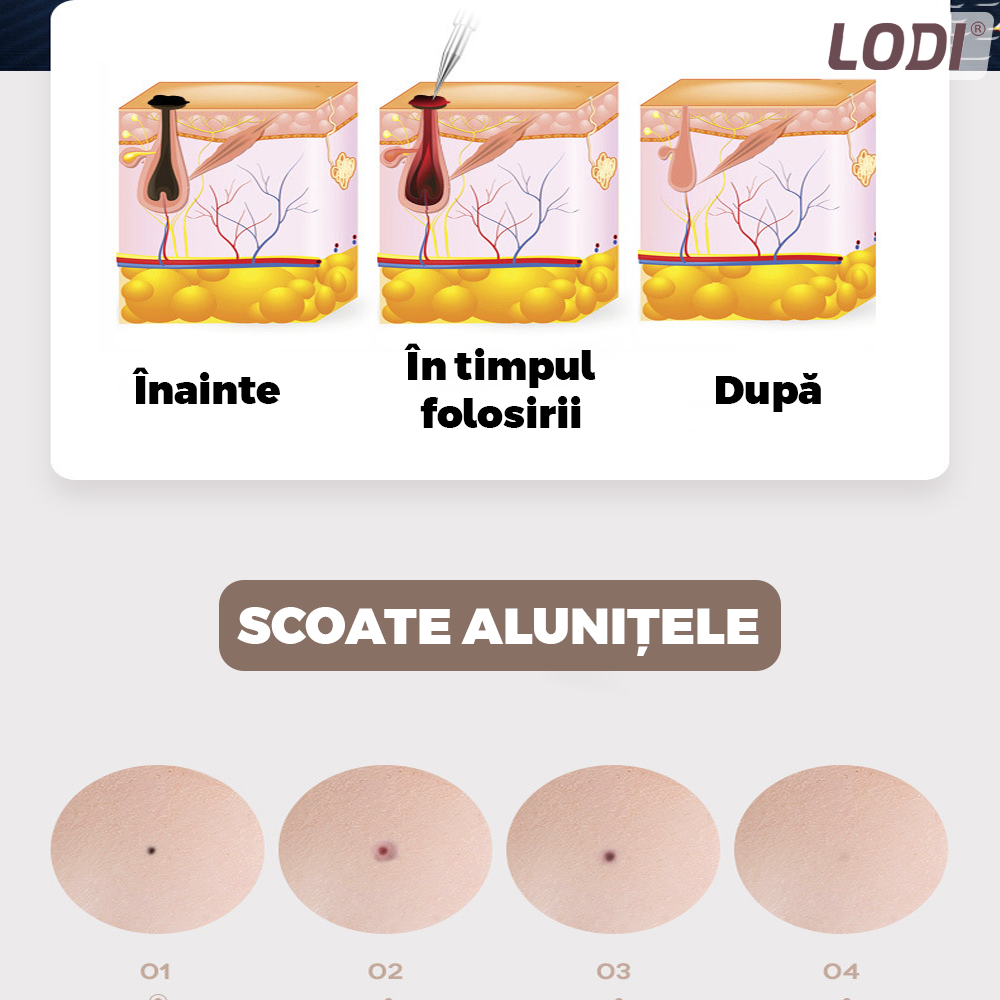 Aparat Plasma Pen Lodi524, 9 viteze, 5 ace de schimb incluse, indepartarea alunite, pete, negi, cicatrici, tatuaje, pistrui, lifting pleoape, afisaj LCD, auriu
