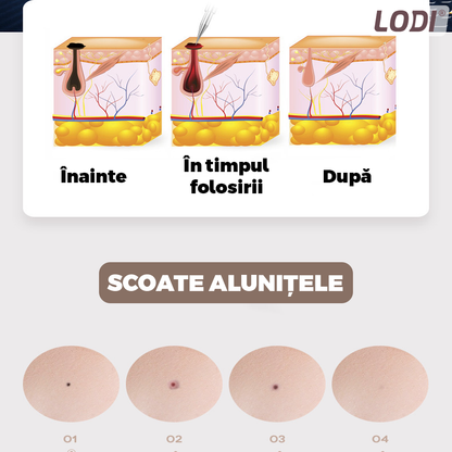 Aparat Plasma Pen Lodi524, 9 viteze, 5 ace de schimb incluse, indepartarea alunite, pete, negi, cicatrici, tatuaje, pistrui, lifting pleoape, afisaj LCD, auriu